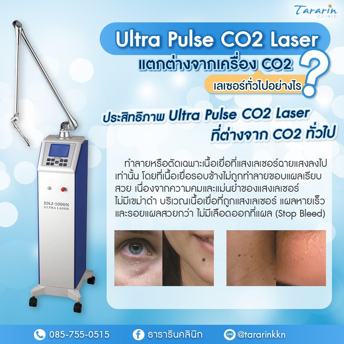 CO2 Laser Ultra Pulse